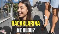 Ünlü şarkıcı Berkay'ın eşi Özlem Ada Şahin'in bacaklarına ne oldu? | Hayatına dair sırları paylaştı!