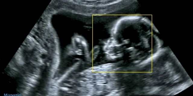 Ultrasonda Bebeğinin Yüzünü Gören Kadın Şoke Oldu