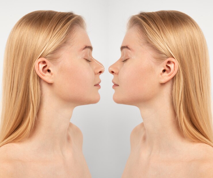 Rhinoplasty Surgery Concept With Woman Model 23 2150036908